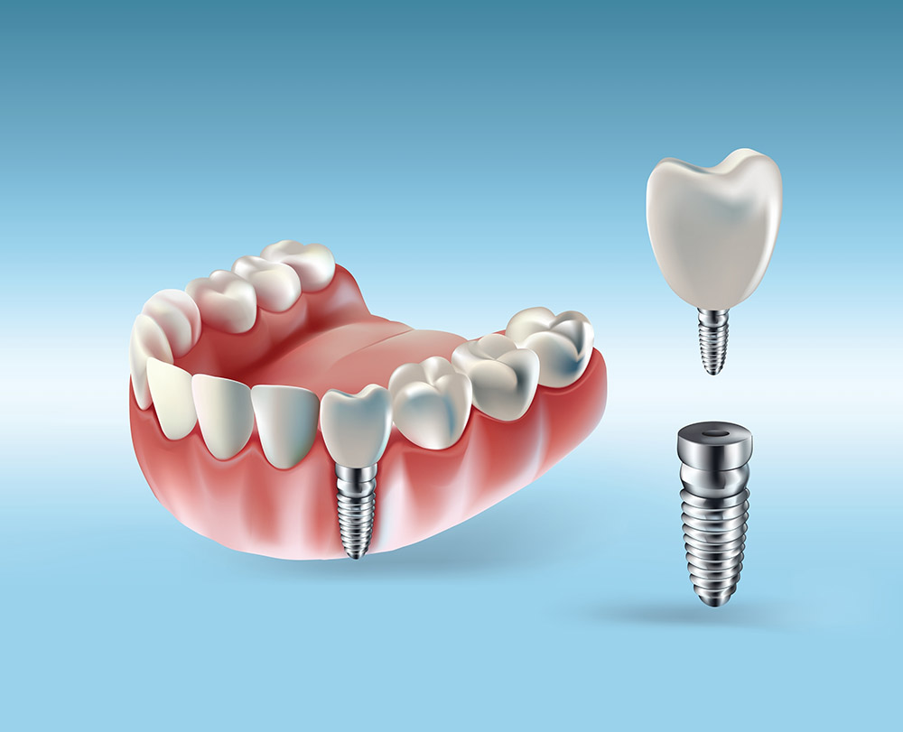 Implant Dentar