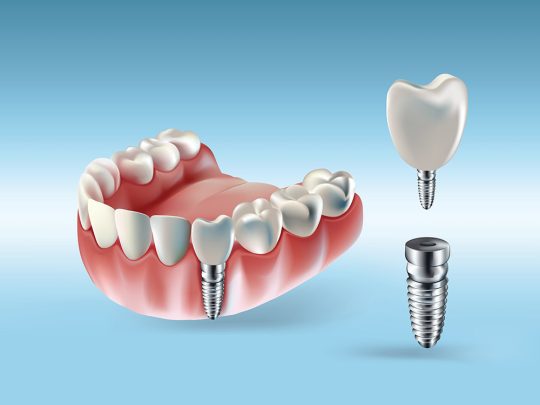 Implant Dentar